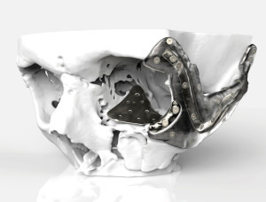 3D nyomtatott titán csontpótlás